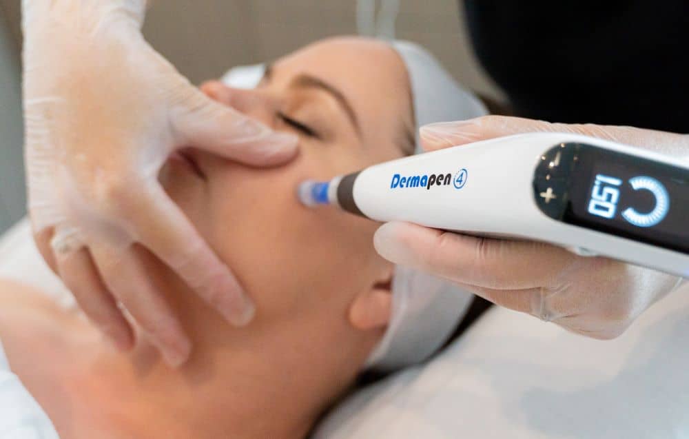 Skin needling helps reduce hyper-pigmentation by breaking up the pigment below the skin surface.