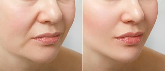 Dermafrac treatment combines microneedling and microdermabrasion to resurface the skin.